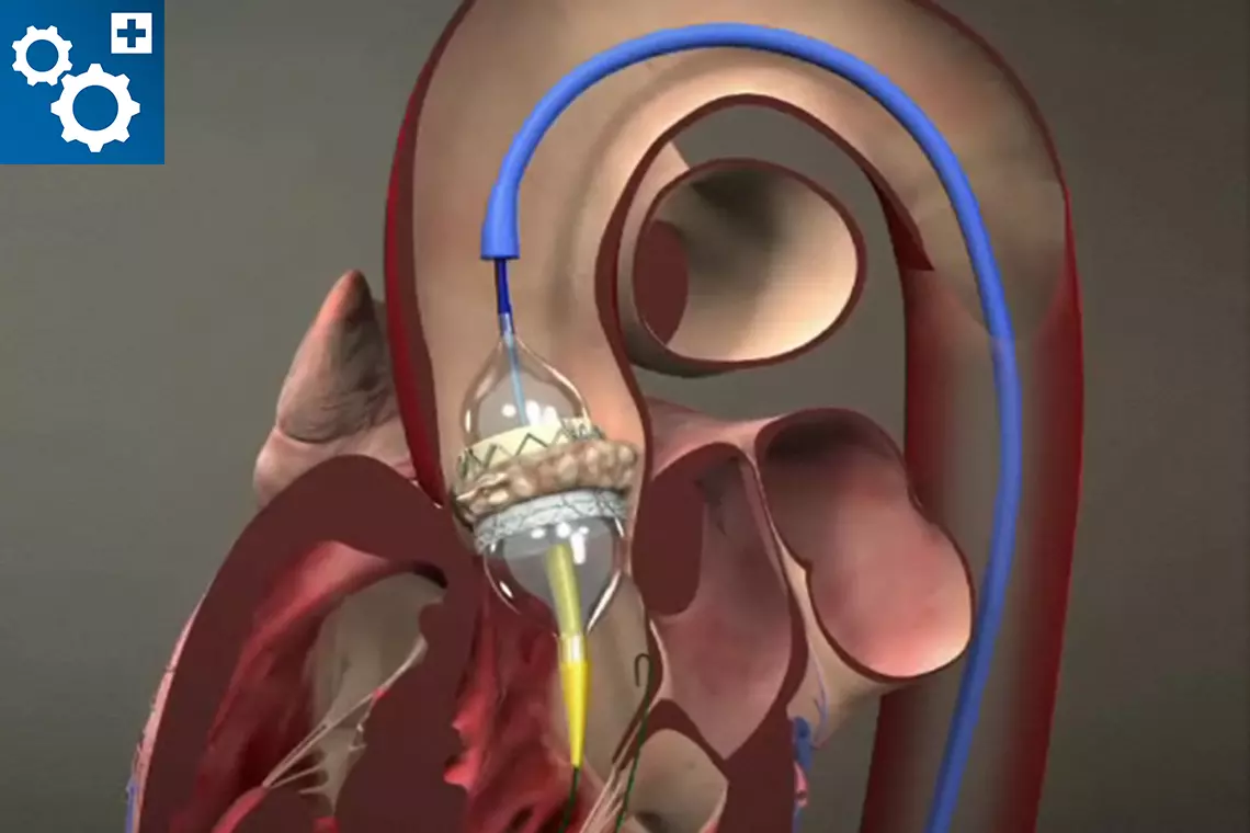 Placement of a SAPIEN transcatheter heart valve (Edwards Lifesciences Corp.)